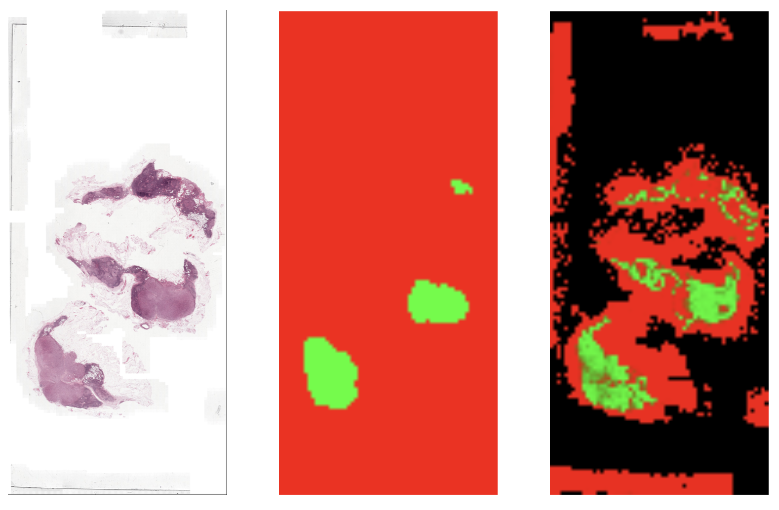 A pathology image of a lymph node, next to two images showing the classification of the lymph node into positive and negative areas.